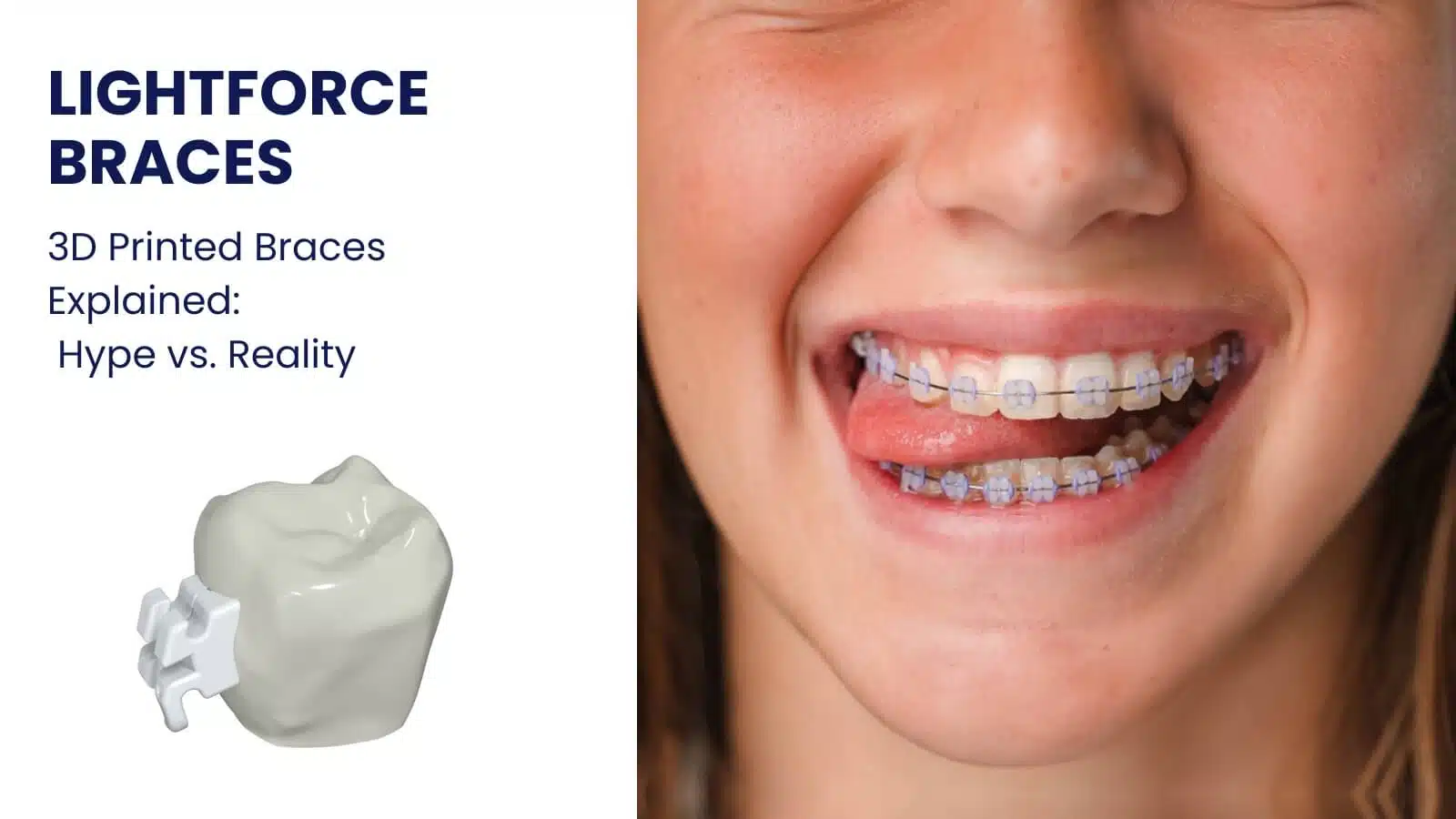 LightForce clear braces option photo