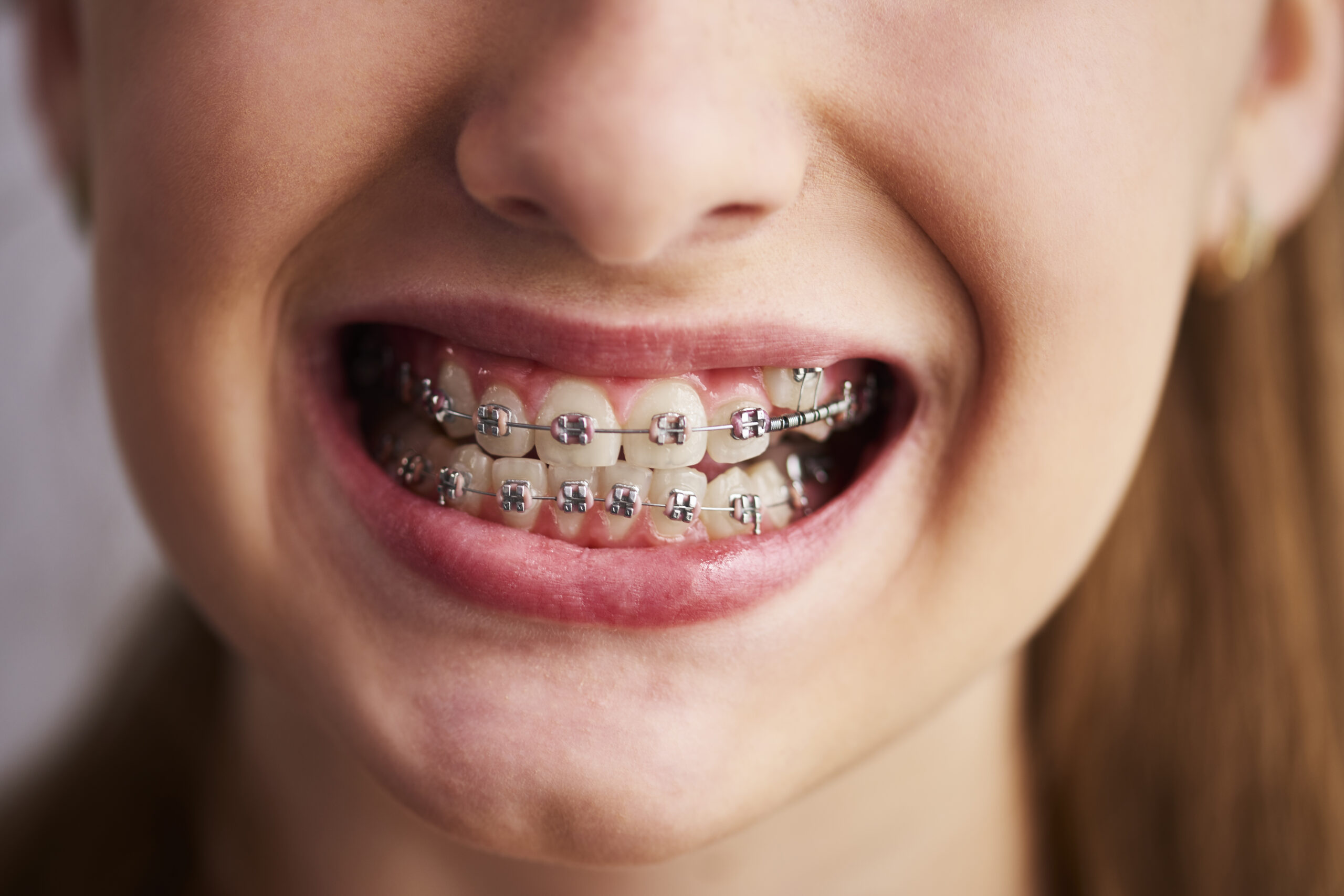 Metal braces option photo