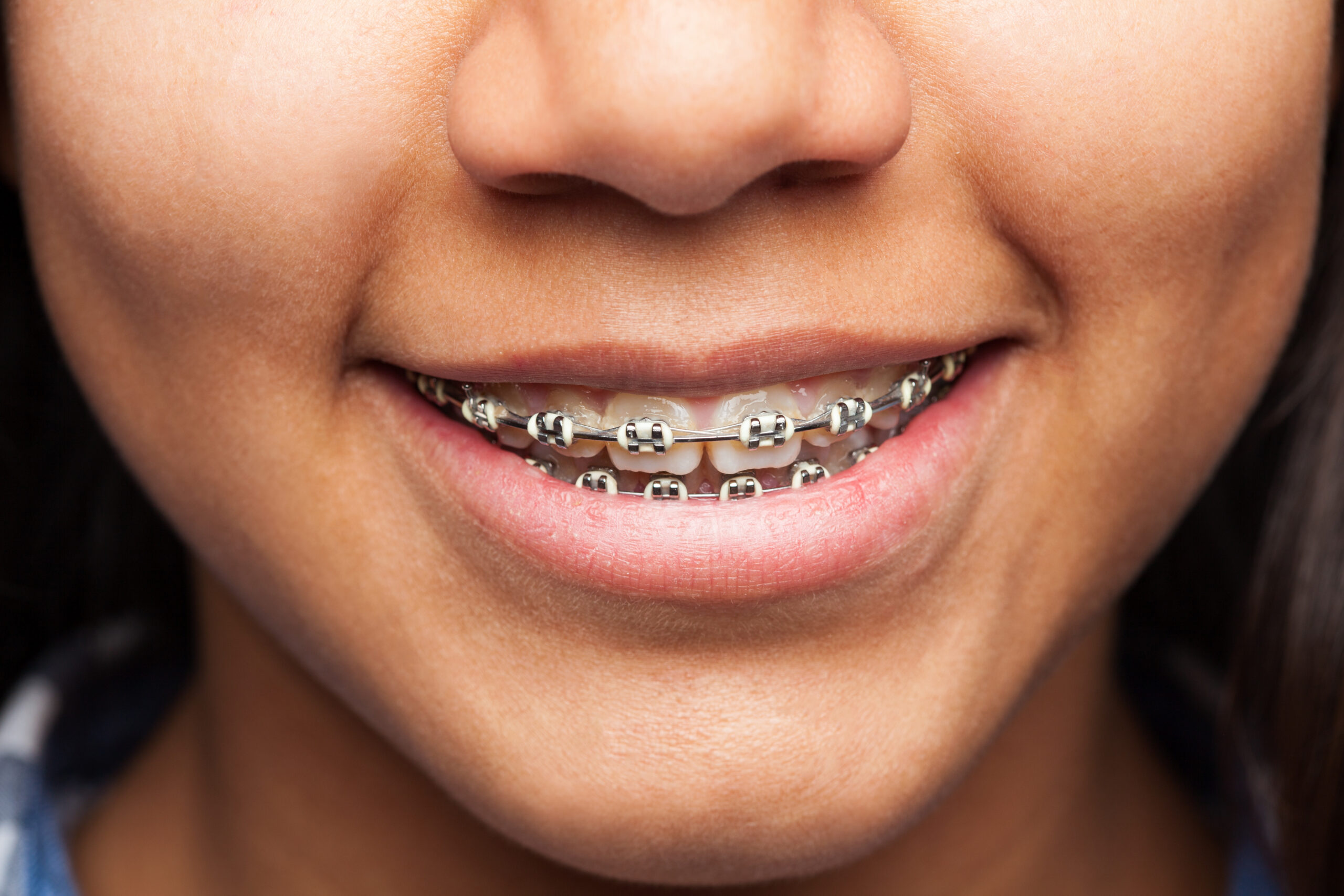 Metal braces smile close-up